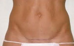 cicatriz resultado de una abdominoplastia