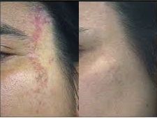 técnicas anti-cicatrices